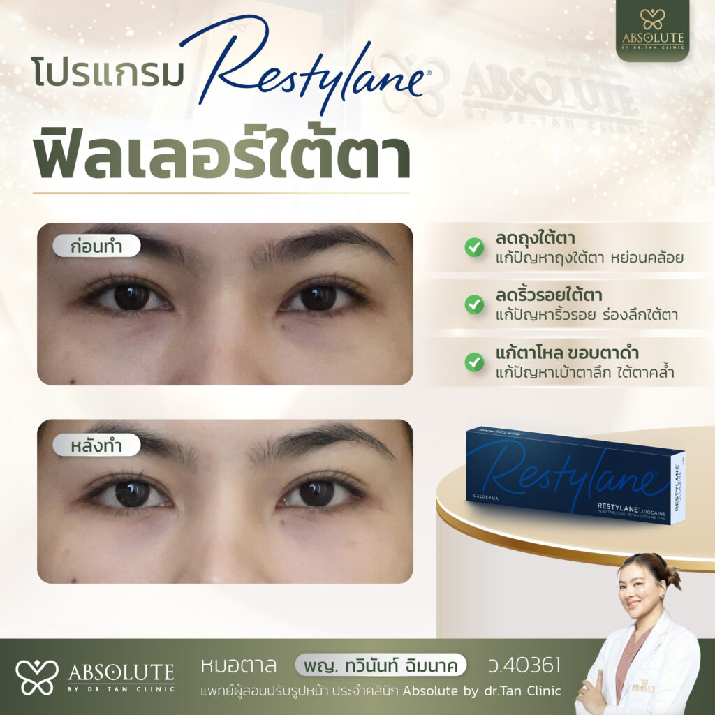 Restalon Restylane พิษณุโลก Absolute Clinic ฟิลเลอร์สวีเดนมาตรฐานโลก